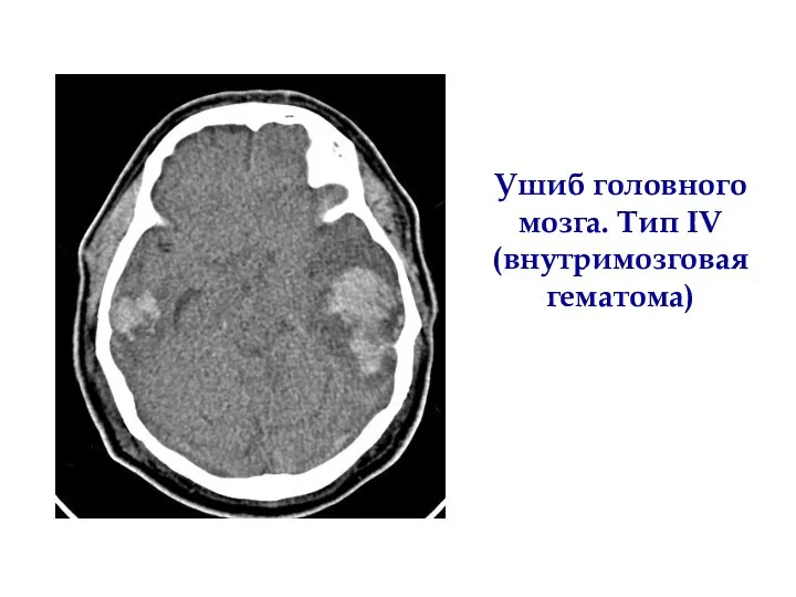 Ушиб головного мозга. Тип IV (внутримозговая гематома)