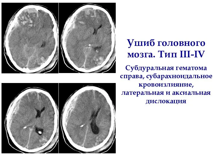 Ушиб головного мозга. Тип III-IV Субдуральная гематома справа, субарахноидальное кровоизлияние, латеральная и аксиальная дислокация
