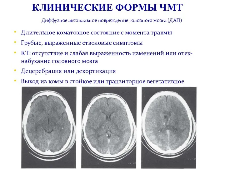 Диффузное аксональное повреждение головного мозга (ДАП) Длительное коматозное состояние с момента травмы