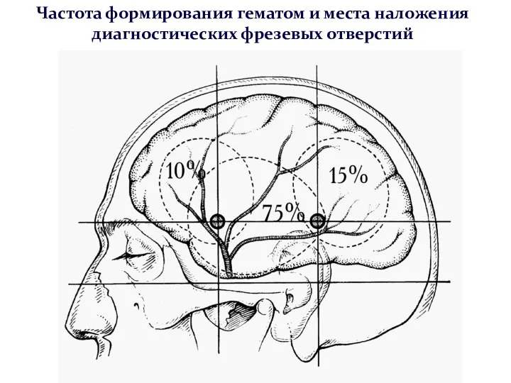 Частота формирования гематом и места наложения диагностических фрезевых отверстий