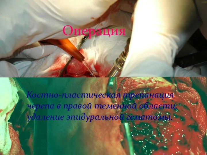 Операция Костно-пластическая трепанация черепа в правой теменной области, удаление эпидуральной гематомы.