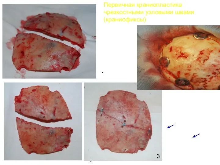 Первичная краниопластика чрезкостными узловыми швами (краниофиксы) 1 2 4