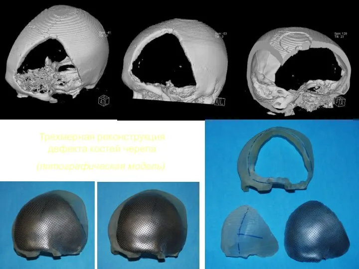 Трехмерная реконструкция дефекта костей черепа (литографическая модель)