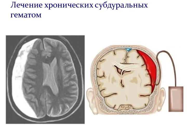 Лечение хронических субдуральных гематом