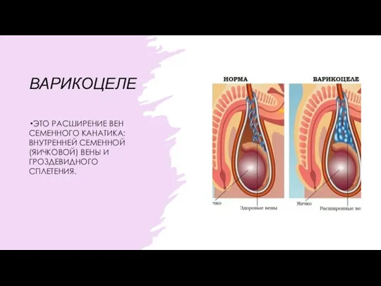 ВАРИКОЦЕЛЕ ЭТО РАСШИРЕНИЕ ВЕН СЕМЕННОГО КАНАТИКА: ВНУТРЕННЕЙ СЕМЕННОЙ (ЯИЧКОВОЙ) ВЕНЫ И ГРОЗДЕВИДНОГО СПЛЕТЕНИЯ.