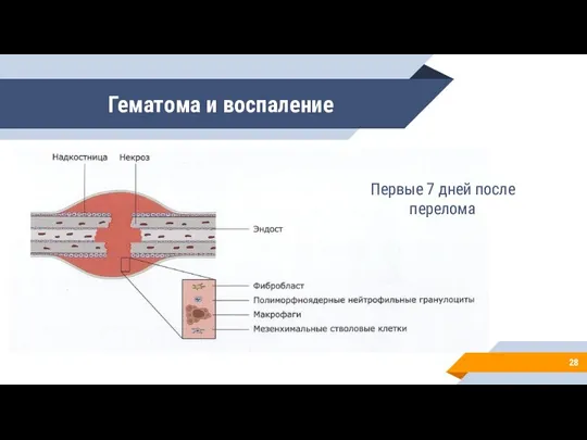 Гематома и воспаление Первые 7 дней после перелома