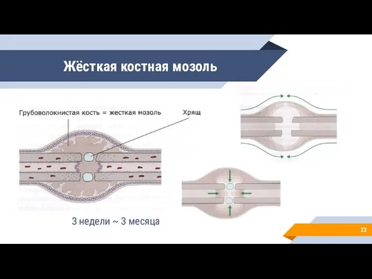 Жёсткая костная мозоль 3 недели ~ 3 месяца