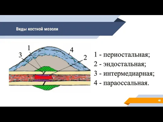 Виды костной мозоли