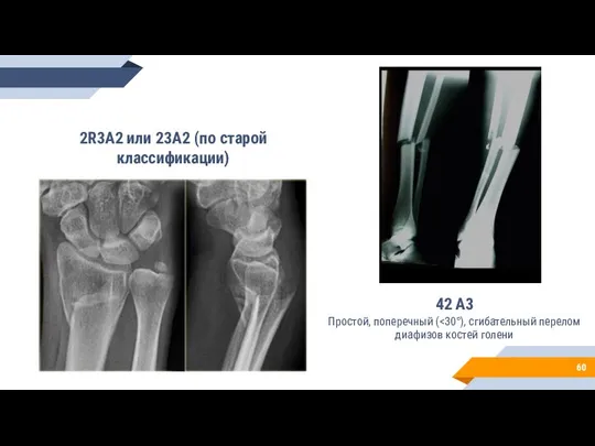 42 А3 Простой, поперечный ( 2R3A2 или 23А2 (по старой классификации)