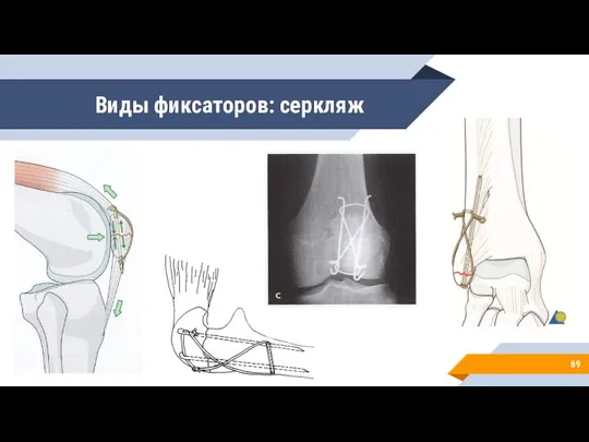 Виды фиксаторов: серкляж