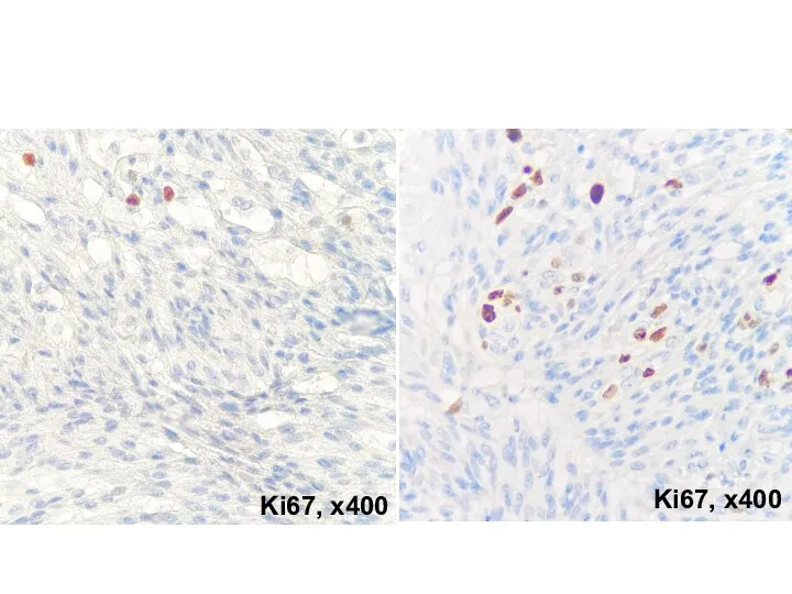 Ki67, х400 Ki67, х400