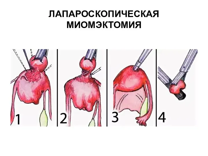 ЛАПАРОСКОПИЧЕСКАЯ МИОМЭКТОМИЯ