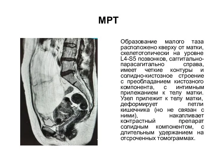 МРТ Образование малого таза расположено кверху от матки, скелетотопически на уровне L4-S5