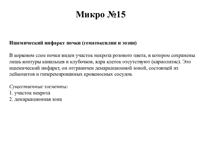 Ишемический инфаркт почки (гематоксилин и эозин) В корковом слое почки виден участок