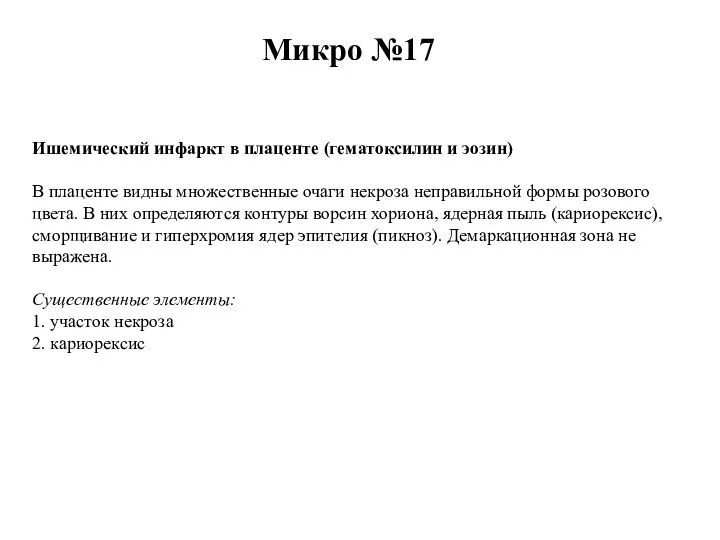 Микро №17 Ишемический инфаркт в плаценте (гематоксилин и эозин) В плаценте видны