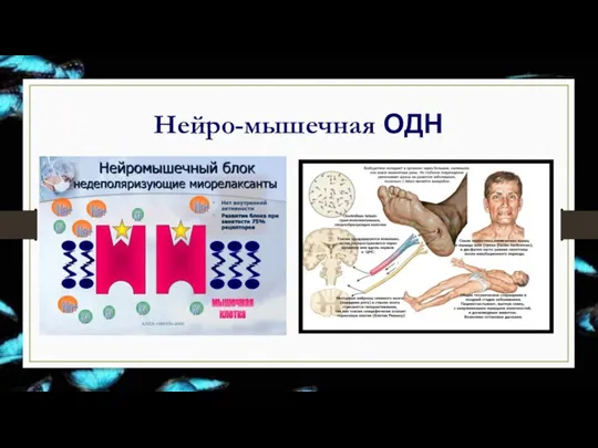 Нейро-мышечная ОДН