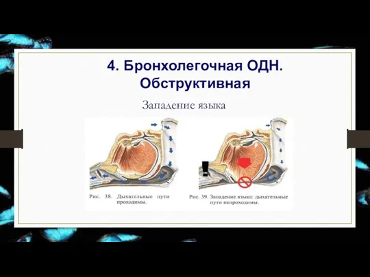 4. Бронхолегочная ОДН. Обструктивная Западение языка