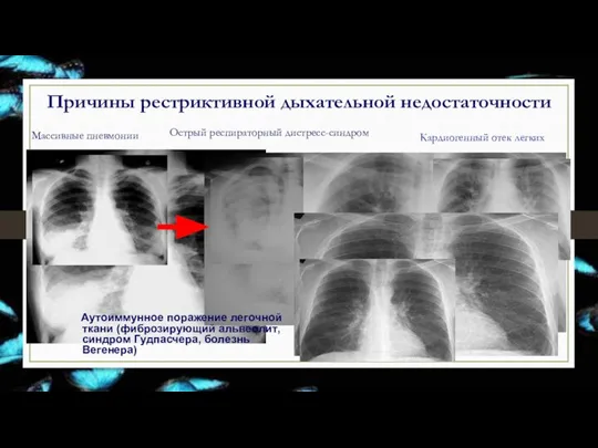 Причины рестриктивной дыхательной недостаточности Массивные пневмонии Острый респираторный дистресс-синдром Кардиогенный отек легких