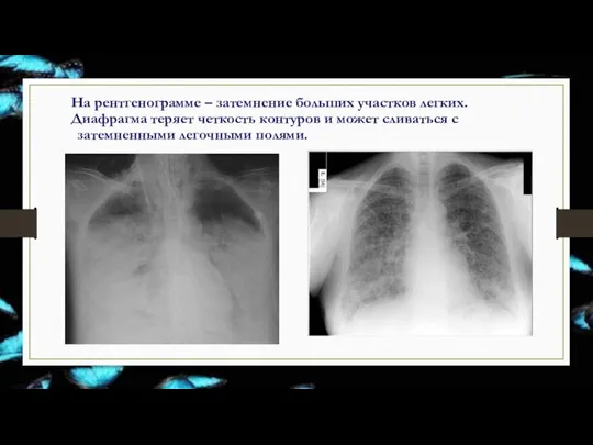На рентгенограмме – затемнение больших участков легких. Диафрагма теряет четкость контуров и