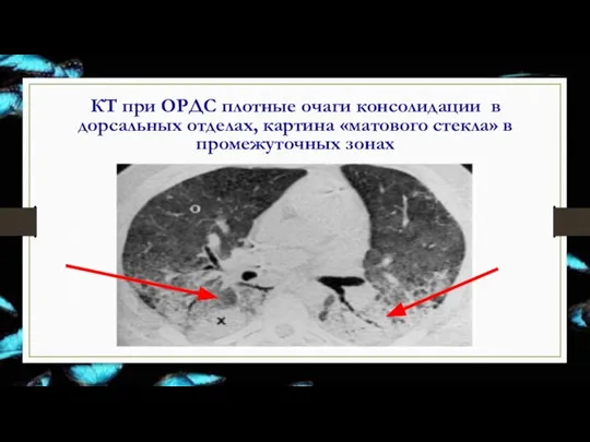 КТ при ОРДС плотные очаги консолидации в дорсальных отделах, картина «матового стекла» в промежуточных зонах