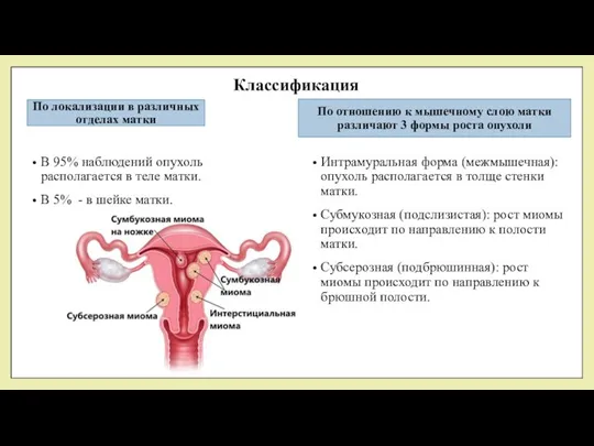 Классификация По локализации в различных отделах матки В 95% наблюдений опухоль располагается