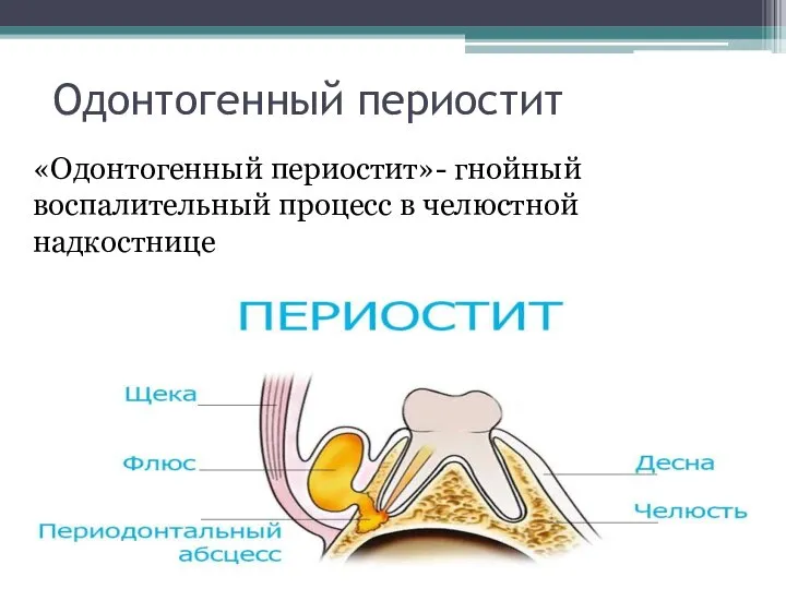 Одонтогенный периостит «Одонтогенный периостит»- гнойный воспалительный процесс в челюстной надкостнице