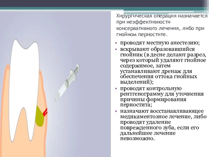 Хирургическая операция назначается при неэффективности консервативного лечения, либо при гнойном периостите. проводят