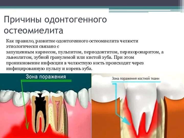 Причины одонтогенного остеомиелита Как правило, развитие одонтогенного остеомиелита челюсти этиологически связано с