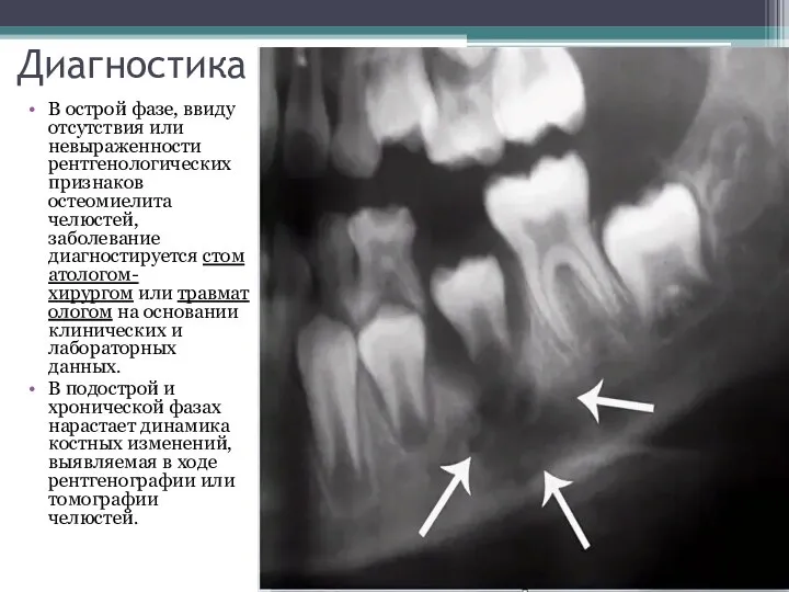Диагностика В острой фазе, ввиду отсутствия или невыраженности рентгенологических признаков остеомиелита челюстей,
