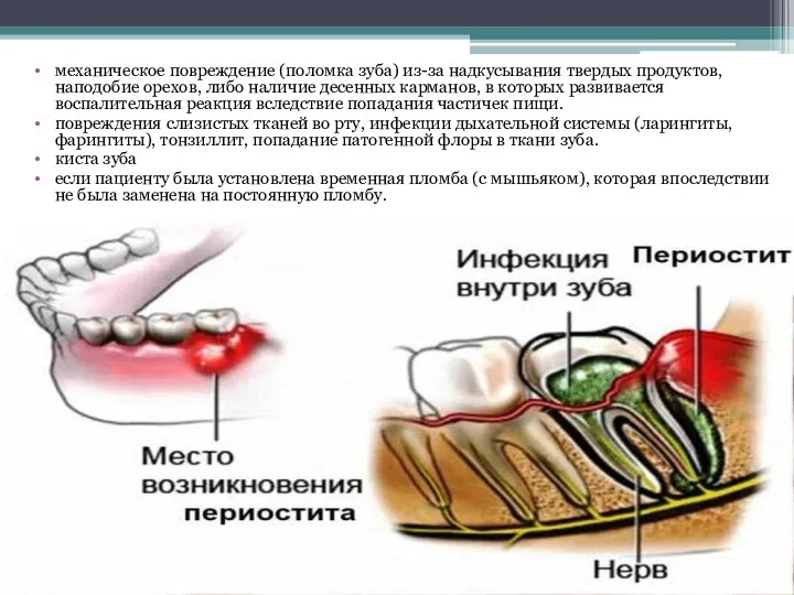 механическое повреждение (поломка зуба) из-за надкусывания твердых продуктов, наподобие орехов, либо наличие