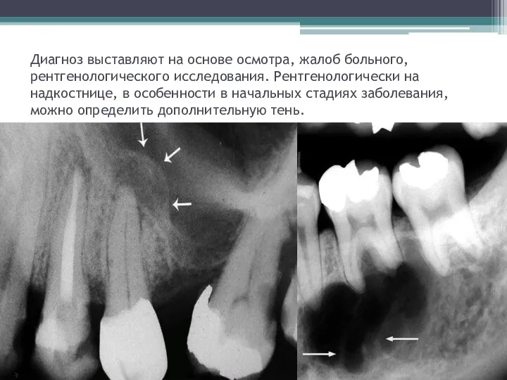 Диагноз выставляют на основе осмотра, жалоб больного, рентгенологического исследования. Рентгенологически на надкостнице,