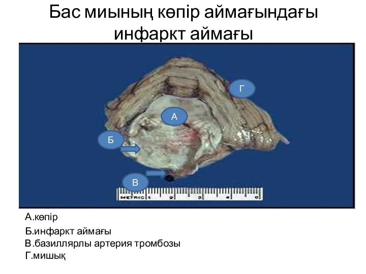 Бас миының көпір аймағындағы инфаркт аймағы А.көпір Б.инфаркт аймағы В.базиллярлы артерия тромбозы