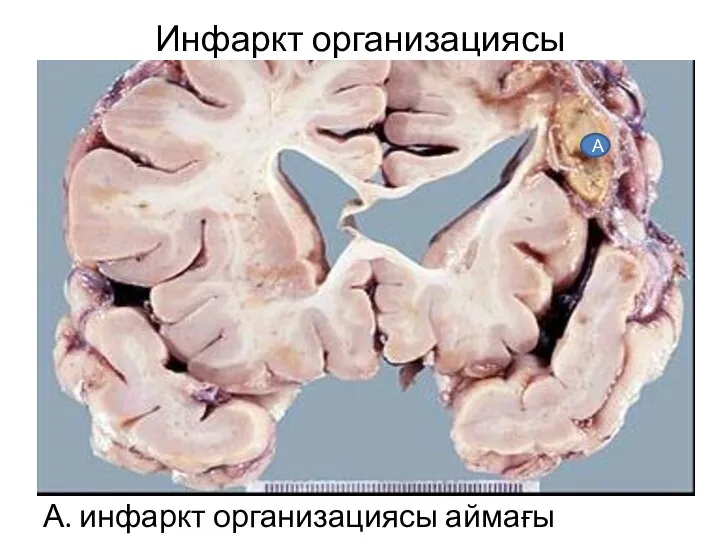 Инфаркт организациясы А. инфаркт организациясы аймағы А