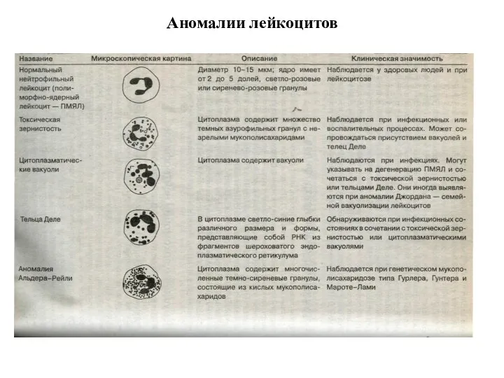 Аномалии лейкоцитов