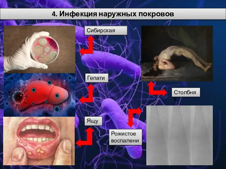 4. Инфекция наружных покровов Сибирская язва Ящур Столбняк Гепатит Рожистое воспаление