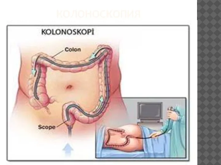 КОЛОНОСКОПИЯ