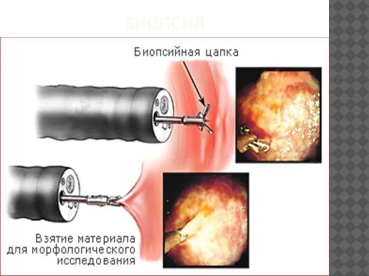 БИОПСИЯ