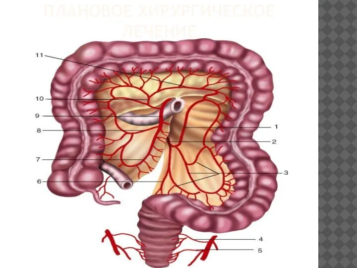 ПЛАНОВОЕ ХИРУРГИЧЕСКОЕ ЛЕЧЕНИЕ