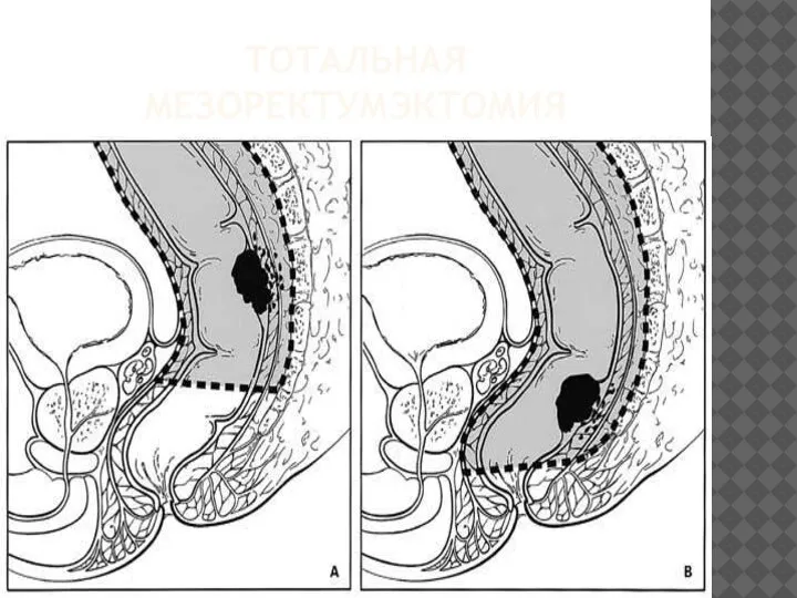 ТОТАЛЬНАЯ МЕЗОРЕКТУМЭКТОМИЯ