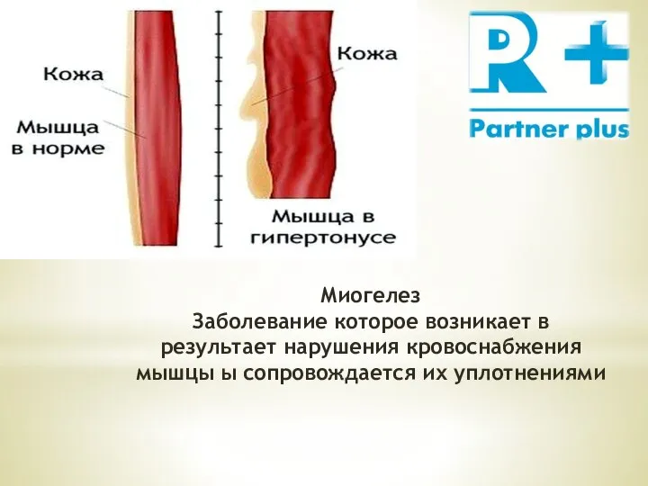 Миогелез Заболевание которое возникает в результает нарушения кровоснабжения мышцы ы сопровождается их уплотнениями