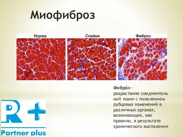 Миофиброз Фибро́з— разрастание соединительной ткани с появлением рубцовых изменений в различных органах,