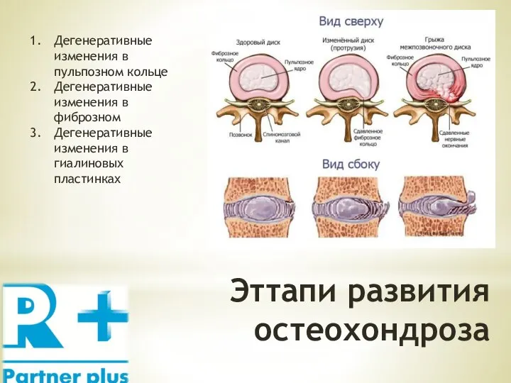 Эттапи развития остеохондроза Дегенеративные изменения в пульпозном кольце Дегенеративные изменения в фиброзном