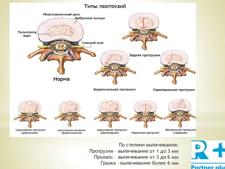 По степени выпячивания: Протрузия – выпячивание от 1 до 3 мм Пролапс