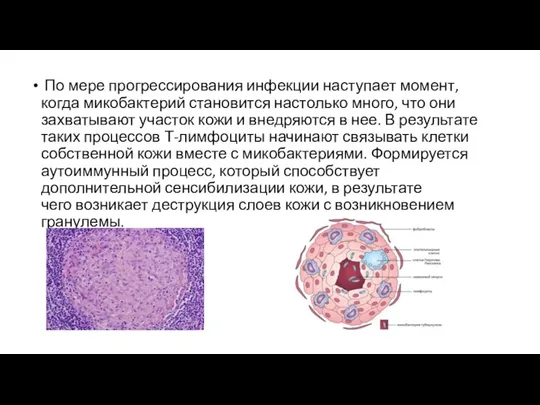 По мере прогрессирования инфекции наступает момент, когда микобактерий становится настолько много, что