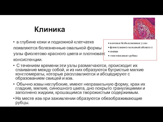 Клиника в глубине кожи и подкожной клетчатке появляются болезненные овальной формы узлы