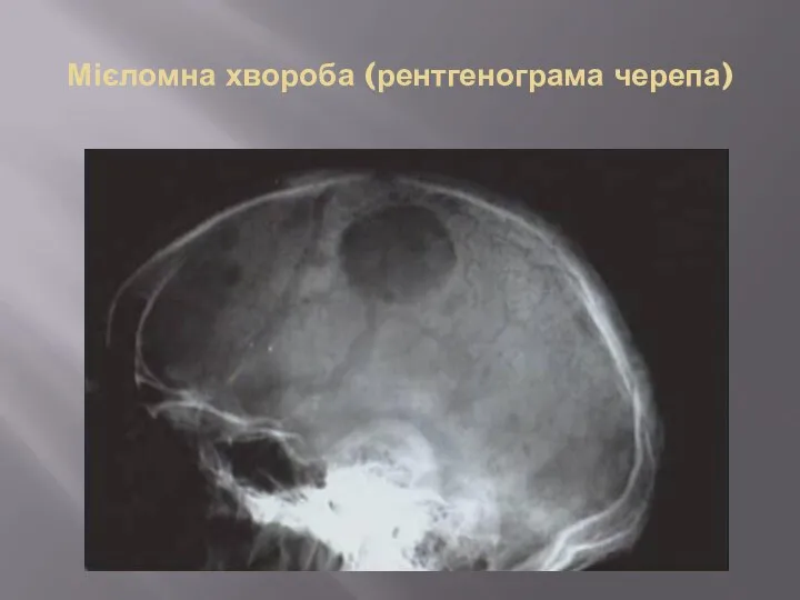 Мієломна хвороба (рентгенограма черепа)