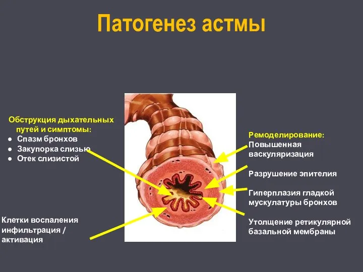 Патогенез астмы Обструкция дыхательных путей и симптомы: Спазм бронхов Закупорка слизью Отек