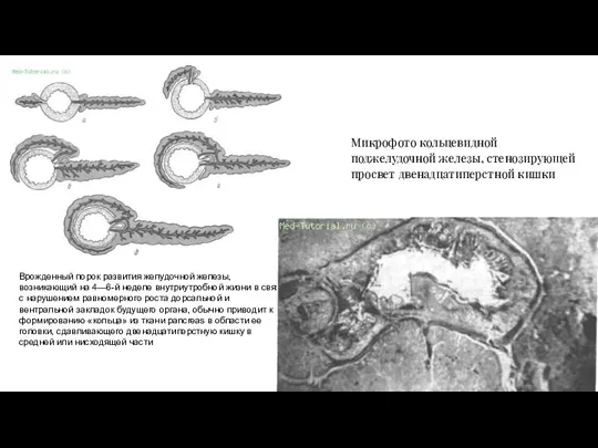 Микрофото кольцевидной поджелудочной железы, стенозирующей просвет двенадцатиперстной кишки Врожденный порок развития желудочной