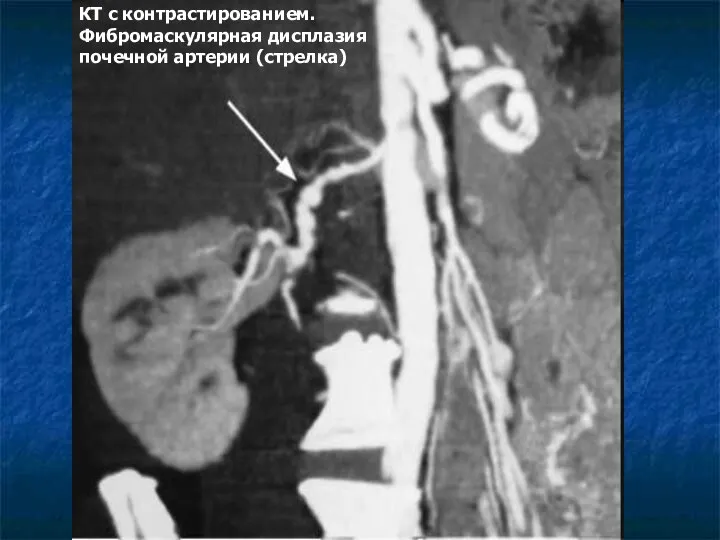 КТ с контрастированием. Фибромаскулярная дисплазия почечной артерии (стрелка)