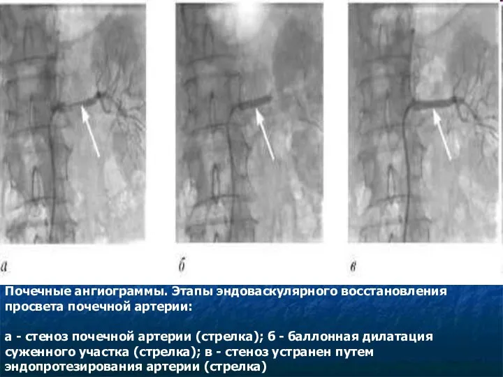 Почечные ангиограммы. Этапы эндоваскулярного восстановления просвета почечной артерии: а - стеноз почечной